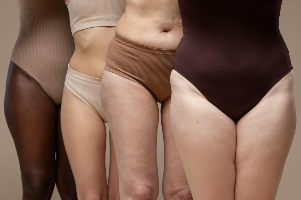 Lipedema